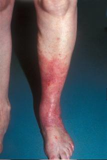 (above) Stasis dermatitis (above)