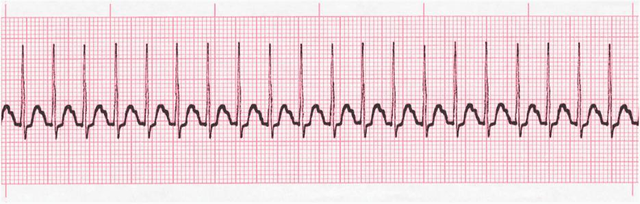 Case Study The Client with Heart Failure A 74-year-old woman is admitted to the hospital with heart failure.