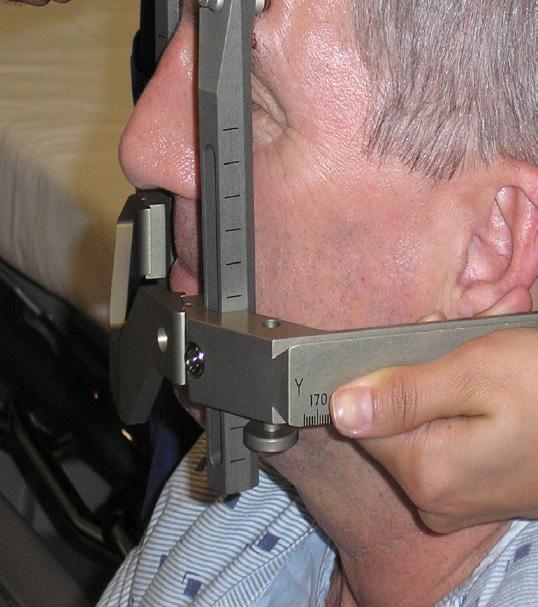 1. Putting your head frame on The stereotactic head frame is an important part of your treatment. It will be put on the morning of your treatment.