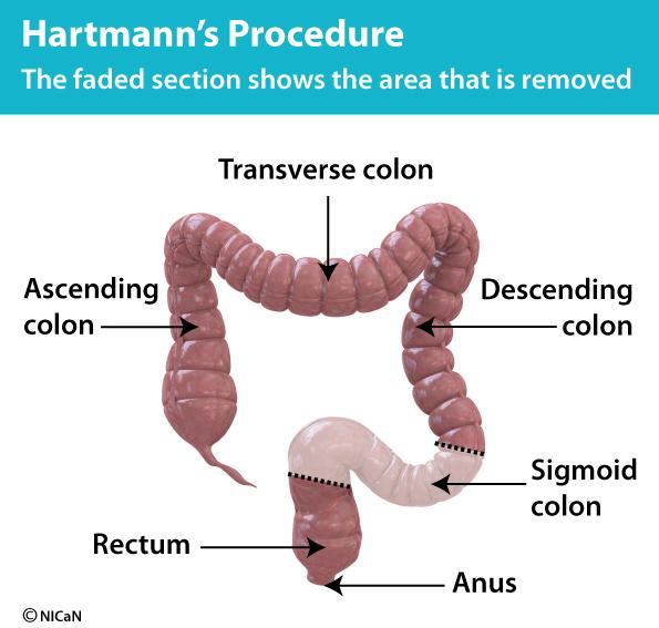 Information to help you make your decision What is Hartmann s Procedure? It is an operation to remove a section of your colon.