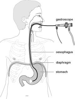 Endoscopy Team Information for Patients Having a Gastroscopy Information for Patients What is a Gastroscopy? You have been advised to have a gastroscopy to help find the cause of your symptoms.
