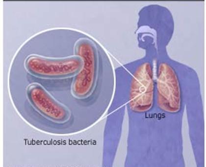 Practical Scenario 2 It is estimated that more than 95% of patients with multidrug resistant TB globally are not
