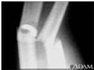 Answer The message: A patient came in today with a really bad fracture. See the picture! Is not an acceptable message. The message provides too much information.