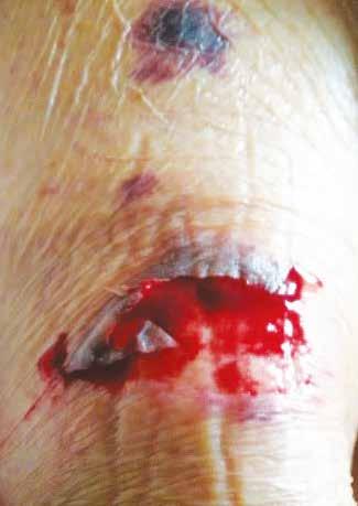 Although STs start as acute wounds, they frequently become painful chronic and complex wounds, which have a high propensity to develop infections.