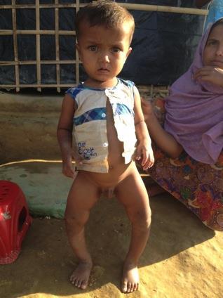) We will start treatment this child s ricket from next week.