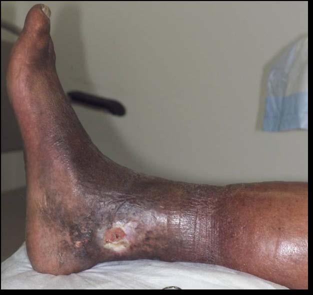 Venous Ulcers Wound may start due to minor trauma. Usual location is lower leg area or medial or lateral malleolus.