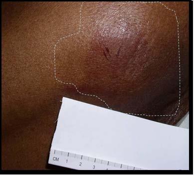 Category/ Stage 1 Pressure Ulcer Intact skin with non-blanchable