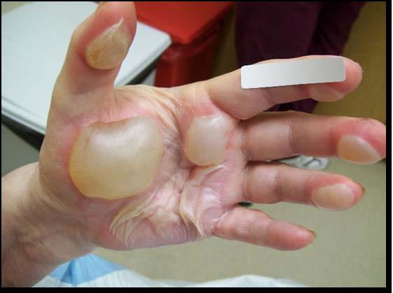 Blisters from Burns 1. What steps should you take to assess this? 2.