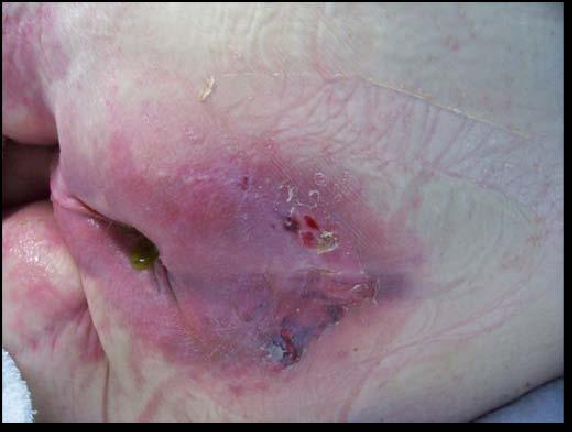 M0300G Unstageable Suspected Deep Tissue Injury 1 Localized area of discolored (darker than surrounding tissue) intact skin. Related to damage of underlying soft tissue from pressure and/ or shear.