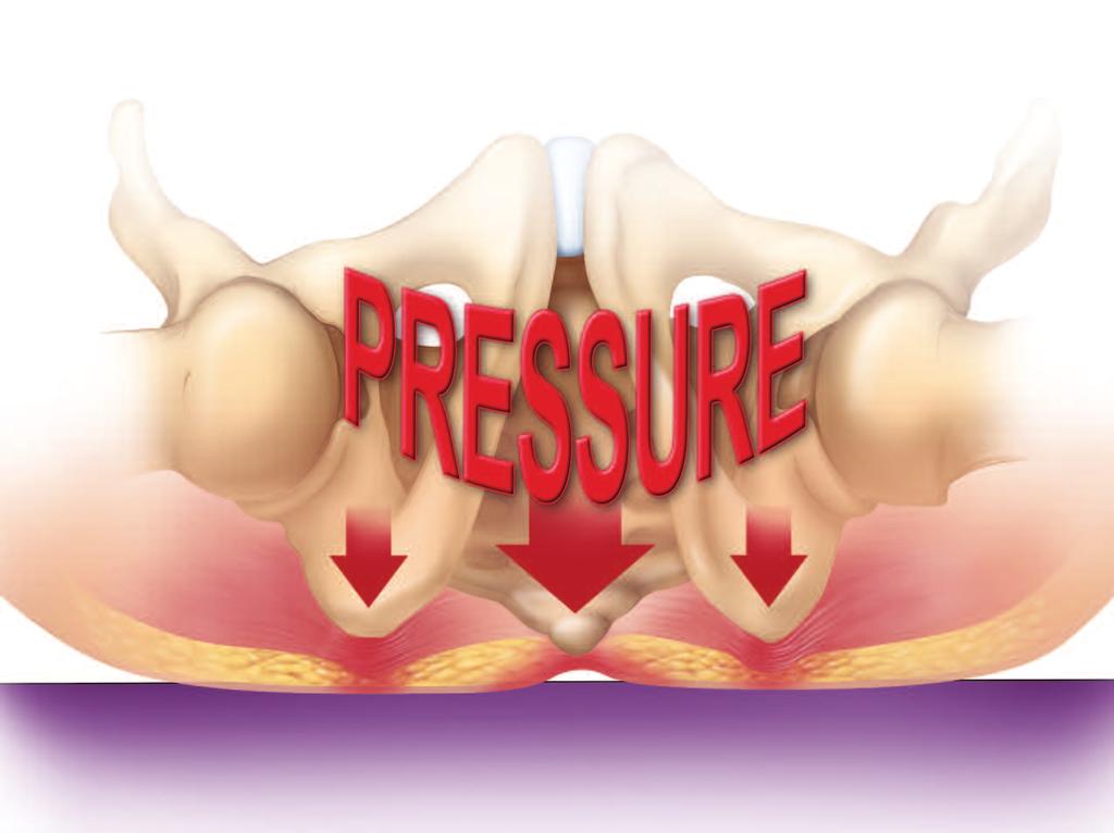 SACRAL PRESSURE ULCERS PREVALENCE, RISK AND COST A pressure ulcer is defined as a localized injury to skin and/or underlying tissue, usually over a bony prominence as a result of pressure, or