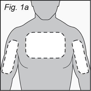 1. Prepare Patient Site ONLY 1 IONSYS system should be applied at any given time. a. Choose healthy, unbroken skin on the upper outer arm or chest ONLY (see Figure 1a). b. Clip excessive hair if necessary.