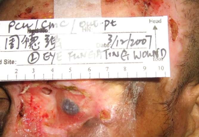 After radiotherapy and antibiotic Left eye wound (12/2007)