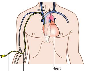 A central line is an intravascular catheter that terminates at or close to the heart or in one of the