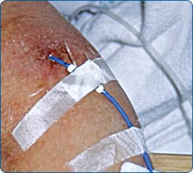 CATHETER OCCLUSION Occlusions can cause serious consequences such as pain, infiltration, extravasations and line infections When a central venous catheter shows signs of complete or partial