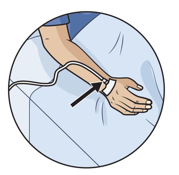 Tube Intravenous (IV) What it's for An intravenous (IV) is a special needle that is put into a vein in your arm or hand.