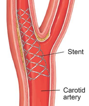 UW MEDICINE PATIENT EDUCATION Stenting for Carotid Artery Dissection How to prepare and what to expect This handout explains stenting for carotid artery dissection, how to prepare for the procedure,
