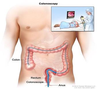 Colonoscopy A colonoscopy is a procedure that allows the endoscopist to look directly at the lining of the large bowel or (colon).