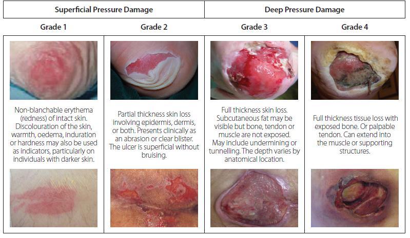 Appendix 9 Pressure Ulcer