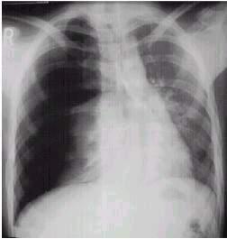 Tension Pneumothorax Air escapes from injured lung pressure builds up in chest Air