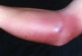 COMPLICATIONS CATHETER-ASSOCIATED INFECTION Cellulitis Definition: Microbial Contamination of catheter or infusion delivery system resulting in Inflammation of the skin and surrounding tissue Causes: