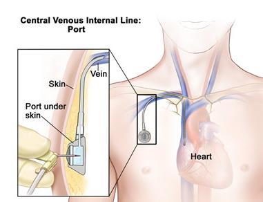 An implanted port is a surgically inserted central venous access device that is placed under the skin for long term