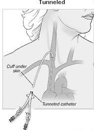 Tunneled (cuffed) Long term therapy, can remain in place months to years Example: Ash Split Cath