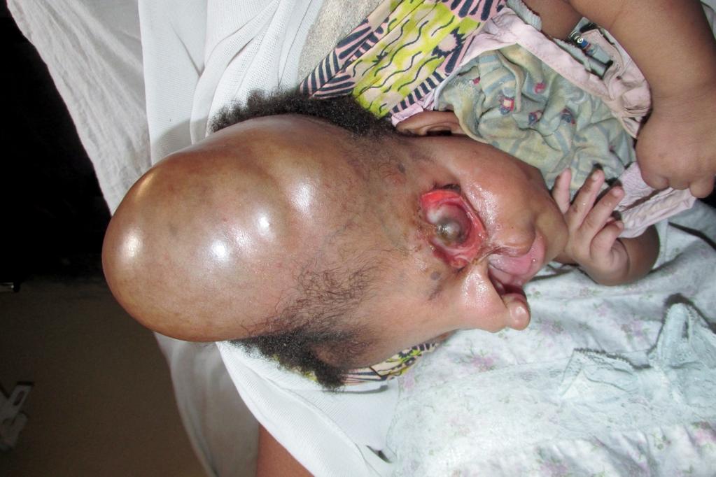 A CHILD BORN WITH MALFORMATION: The child in this photo was born with an abnormality. He has a cleft lip and pallet, tumour on the head and doesn t have eyes.