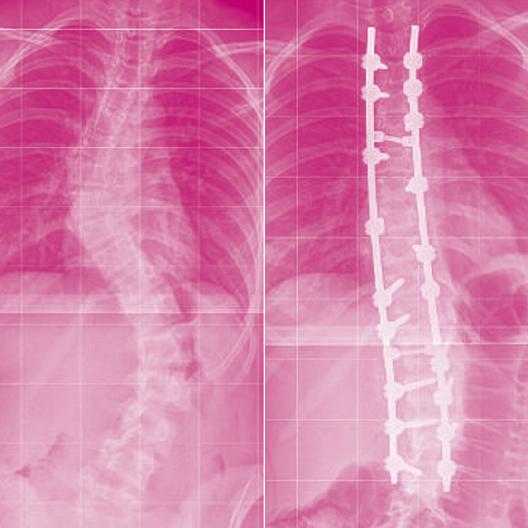 Scoliosis Surgery Ciaran s Journey What is involved in spinal surgery X-ray before