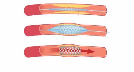 wall. This lets the blood flow through your artery to your heart muscle. After the balloon procedure, your doctor may place a stent in the artery he or she just opened. What is a stent?