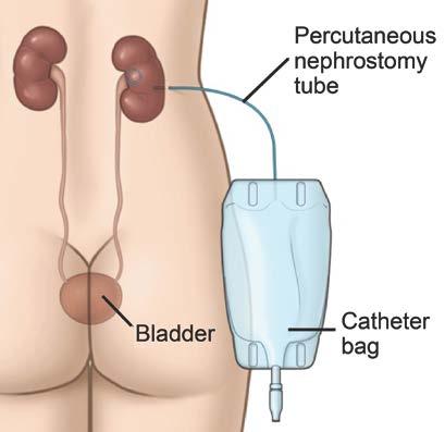 A nephrostomy tube is a small plastic tube. It is placed through your skin (percutaneous) and into your kidney. It will drain urine from your kidney into a catheter bag outside your body.