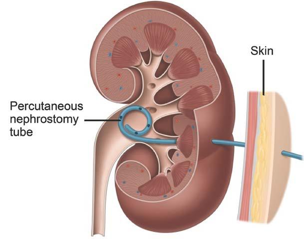 The nephrostomy tube will enter your body through an insertion site in your skin. How long will I need the tube? Nephrostomy tubes may stay in for weeks or months.