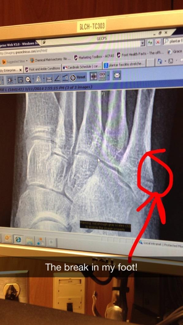 Case Study - Katie Avulsion fracture of the 5 th metatarsal, right foot. ICD-9-CM 825.25 Fracture of other tarsal and metatarsal bones, closed E888.9 Unspecified fall ICD-10-CM S92.