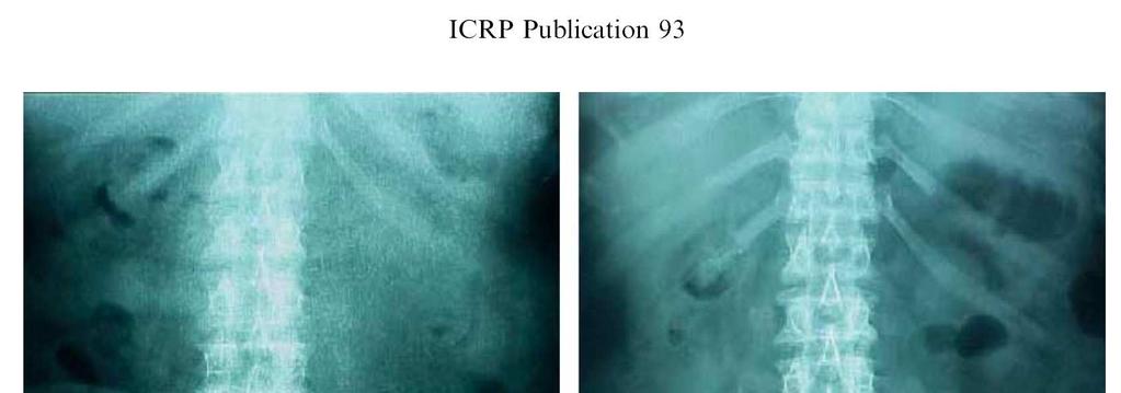 ICRP-93 (2014)