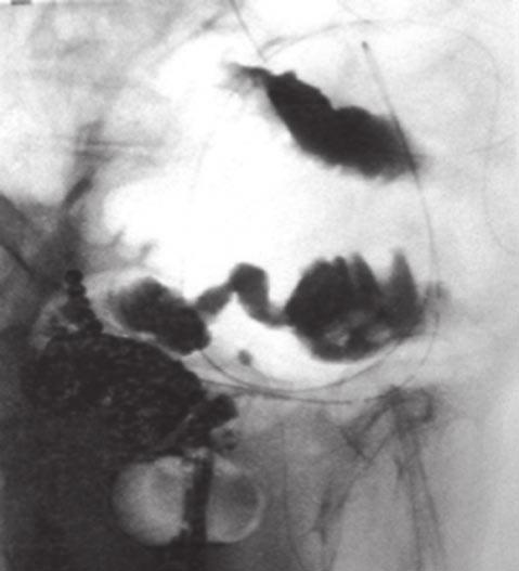 n Figure 2: A-2 Case 2: T.K., 93y/o, F with sigmoid colon cancer l B-1 Case 1: K.S.