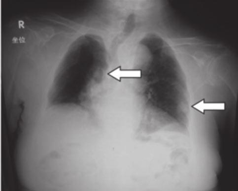 A simple resection for the cancer was performed. n Figure 3: A-3 Case 3: T.S., 91 y/o, F, with right lung cancer A tumor shadow was found r in her right lower lobe at 91 years of age.