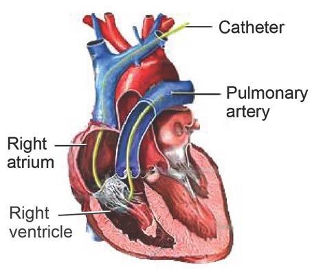 Pulmonary Artery Catheter After blood flows through your body, it returns to the right side of your heart.