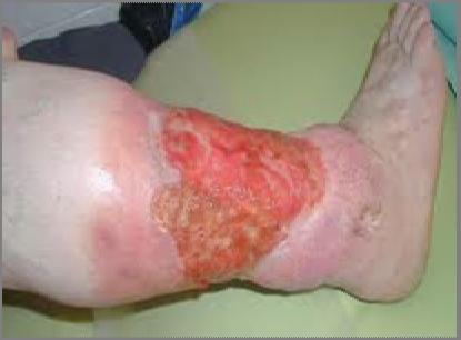 PROVIDES ACCESS TO RURAL REGIONS Patient lives 100 miles from University Hospital Wound Clinic with dermatologists, and
