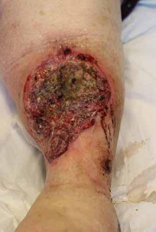 n Calciphylaxis and Martorell Hyperten-sive Ulcers n Hidradenitis Suppurativa n Malignant Ulcers n Artefactal Ulcers n Other Types of Atypical Wounds n Dermato-pathology of Atypical Wounds n Ecthyma
