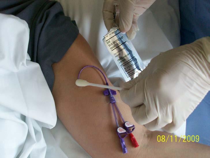 Clean Insertion Site Thoroughly with Chloraprep 3 swabs