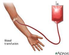 insulin through a programmed pump) Insertion or initiation of